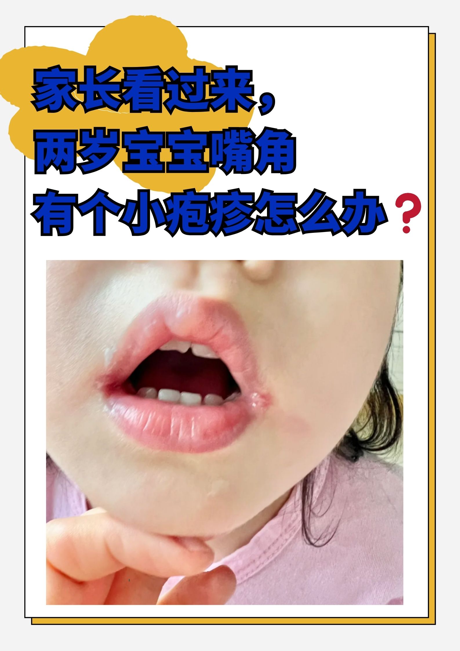 两岁宝宝嘴角小疱疹的常见原因与家庭护理要点